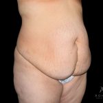 Liposuction Before & After Patient #847