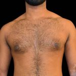 Gynecomastia Before & After Patient #854
