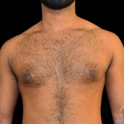 Gynecomastia Before & After Patient #854