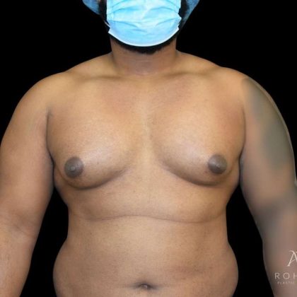 Gynecomastia Before & After Patient #861