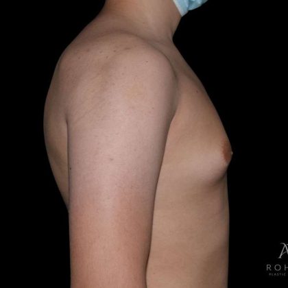 Gynecomastia Before & After Patient #868