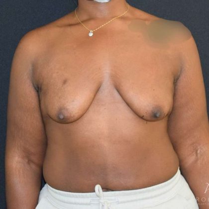 Breast Lift Before & After Patient #889