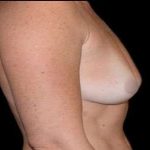 Breast Augmentation Before & After Patient #980
