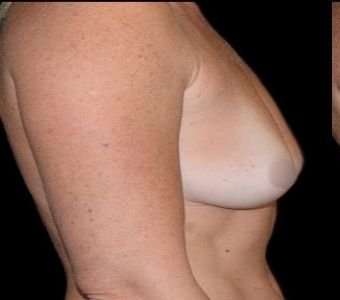 Breast Augmentation Before & After Patient #980