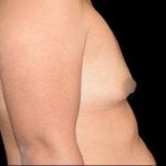 Breast Augmentation Before & After Patient #992