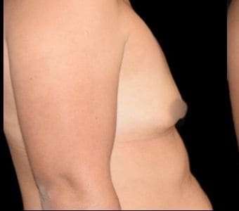 Breast Augmentation Before & After Patient #992