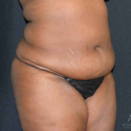 Tummy Tuck Before & After Patient #737