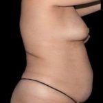 Tummy Tuck Before & After Patient #744