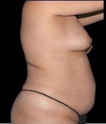 Tummy Tuck Before & After Patient #744