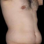 Tummy Tuck Before & After Patient #756