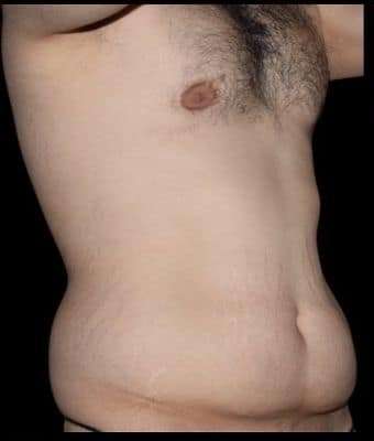 Tummy Tuck Before & After Patient #756