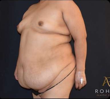 Mommy Makeover Before & After Patient #383