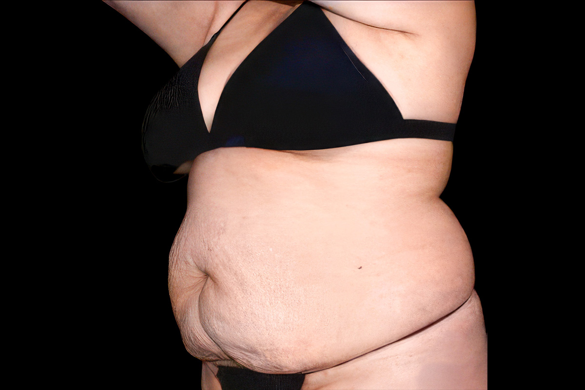 Patient torso before body contouring