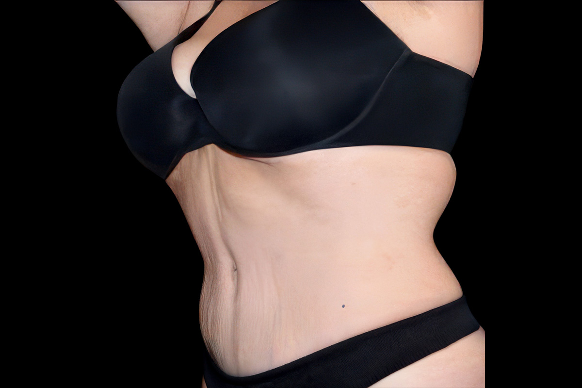 Patient torso after body contouring