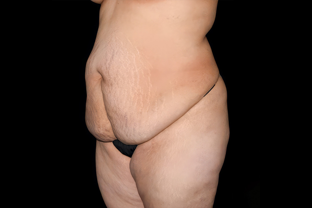 Patient torso before body contouring