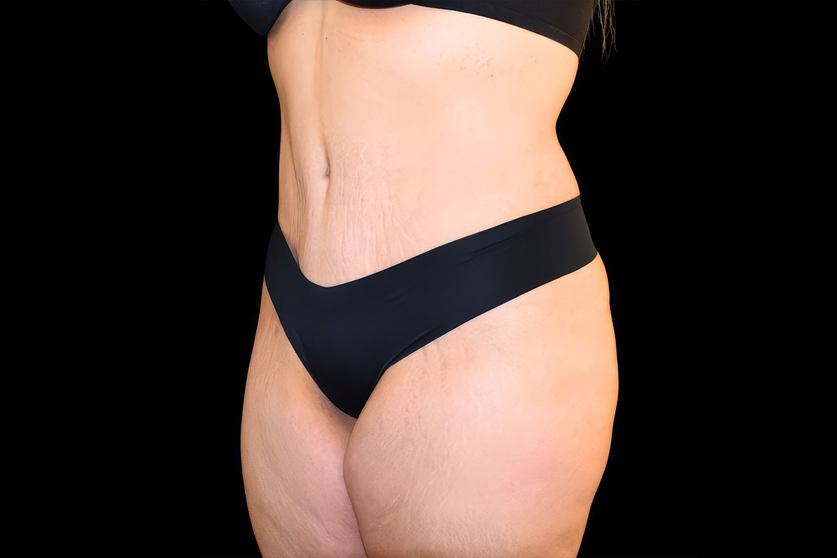 Patient torso after body contouring