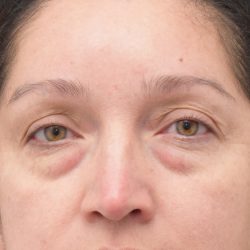 Blepharoplasty Before & After Patient #1895