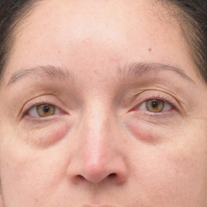 Blepharoplasty Before & After Patient #1895