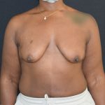 Breast Augmentation with Lift Before & After Patient #1810