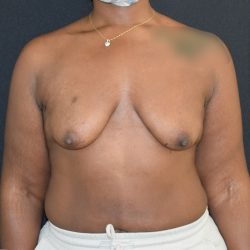 Breast Augmentation with Lift Before & After Patient #1810