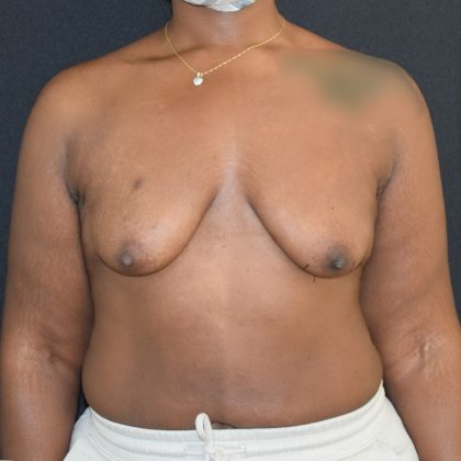 Breast Augmentation with Lift Before & After Patient #1810