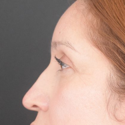 Blepharoplasty Before & After Patient #1895