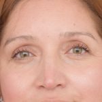 Blepharoplasty Before & After Patient #1895