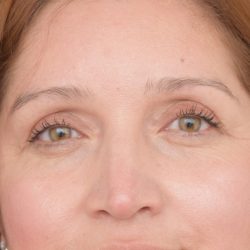 Blepharoplasty Before & After Patient #1895