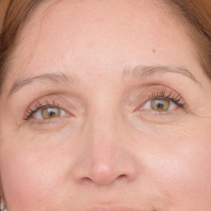 Blepharoplasty Before & After Patient #1895