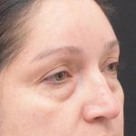 Blepharoplasty Before & After Patient #1895