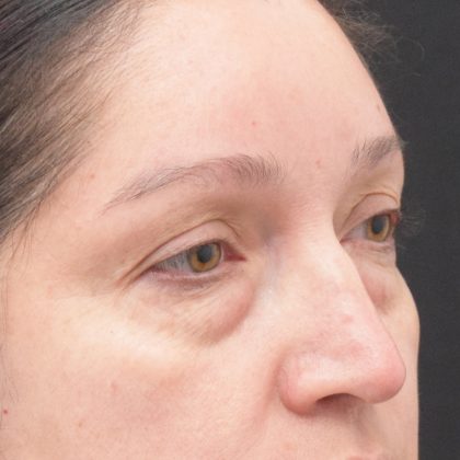 Blepharoplasty Before & After Patient #1895