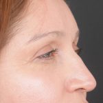 Blepharoplasty Before & After Patient #1895