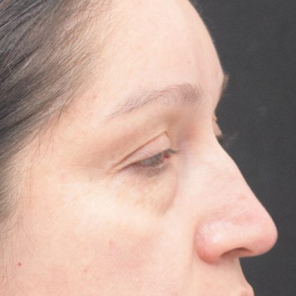 Blepharoplasty Before & After Patient #1895