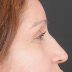 Blepharoplasty Before & After Patient #1895