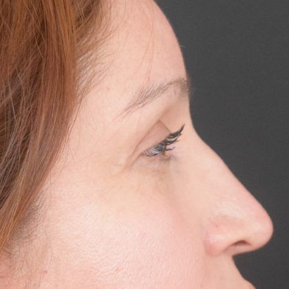 Blepharoplasty Before & After Patient #1895