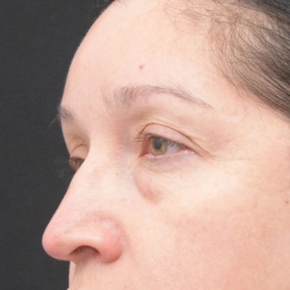 Blepharoplasty Before & After Patient #1895