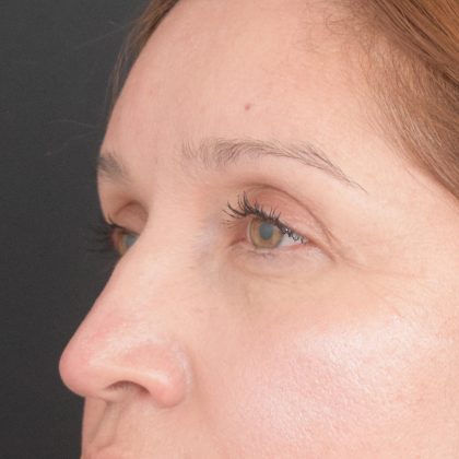 Blepharoplasty Before & After Patient #1895