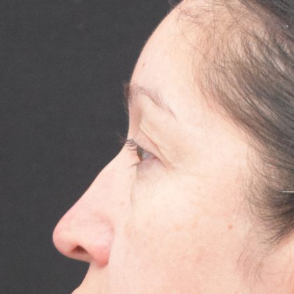 Blepharoplasty Before & After Patient #1895