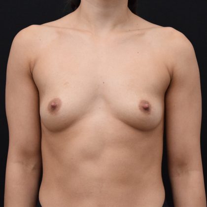 Breast Augmentation Before & After Patient #1896