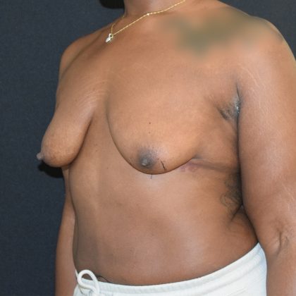 Breast Augmentation with Lift Before & After Patient #1810