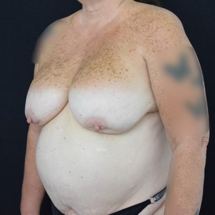 Breast Implant Exchange with Lift Before & After Patient #1813