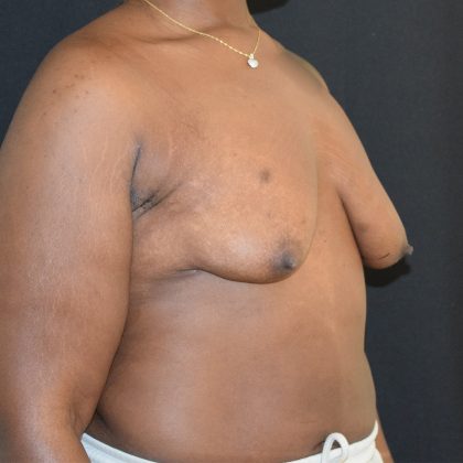Breast Augmentation with Lift Before & After Patient #1810